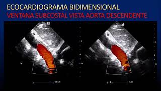 Generalidades de ecocardiograma doppler color [upl. by Prosperus]