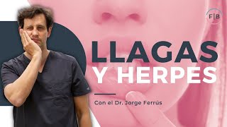 👉¿LLAGA o HERPES LABIAL Diferencias y cómo CURARLO [upl. by Macmillan]