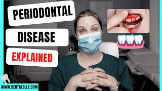 Periodontal Disease and the Pockets Explained [upl. by Yrol]