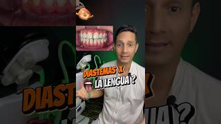 Diastemas por culpa de la LEMGUA 😛 brackets ortodoncia diastema [upl. by Yraek]