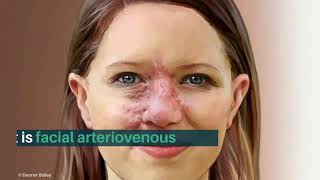 What is Facial Arteriovenous Malformation AVM [upl. by Sparke]