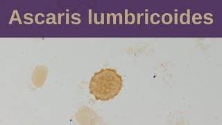 Ascaris Lumbricoides and Ascariasis  Pathology mini tutorial [upl. by Naleag955]