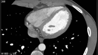 Right Coronary Artery on Axial CT [upl. by Bolling]