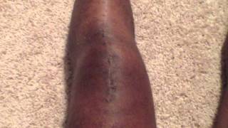 Week 3 Of Recovery of Ruptured Patella Knee Tendon [upl. by Atiuqahc]