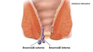 Emorroidectomia [upl. by Subak]