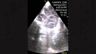 VSCAN Retroperitoneal lymphadenopathy Adenopatías retroperitoneales [upl. by Razec99]