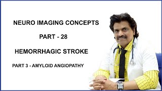 NEURO IMAGING CONCEPTS PART 28HEMORRHAGIC STROKE PART 3 AMYLOID ANGIOPATHY [upl. by Beera262]