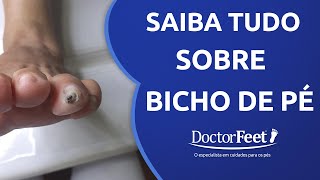 Tudo o que você precisa saber sobre o TRATAMENTO DE BICHO DE PÉ [upl. by Ronal285]