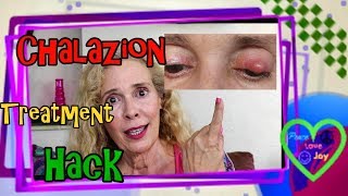 Chalazion Treatment Hack [upl. by Christina]