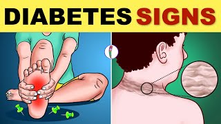 Diabetes Symptoms  Diabetes Mellitus  Type 2 Diabetes  Signs amp Symptoms  Diabetes Warning Signs [upl. by Camm]