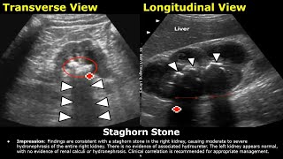 Kidney Ultrasound Reporting  Renal Diseases Scan Reports  How To Write USG Report  KUB USG [upl. by Melborn]