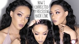 How I Fixed My Hair Line with a Frontal  Aliexpress New Star Hair [upl. by Thinia]