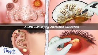 ASMR CARE ANIMATION COLLECTION  Cleaning Big Hole Swollen Ear Dry Eyelid Sebum Extrusion [upl. by Nattie812]