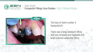 Zen Dental Case Study Composite Fillings 2  Dentist in Seattle Washington 98102 [upl. by Etienne497]