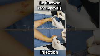 कांडे में स्टीरॉयड इंजेक्शन  De Quervain Tenosynovitis steroid injection ortho injection shorts [upl. by Pich]