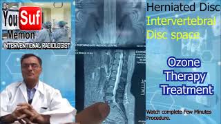 Disc Herniated  Intervertebral Disc Space Treatment  Ozone Injection  Dr Yousuf Memon Case8809 [upl. by Nerreg]