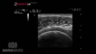 Supraspinatus full thickness tear [upl. by Irb]