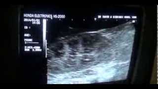 NEPHROTIC SYNDROME as seen by ultrasound [upl. by Asilec887]