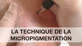 La dermopigmentation capillaire ou Tricopigmentation [upl. by Strain]