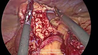 Ovarian Tumor [upl. by Laro]