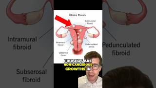 What are uterus FIBROIDS and what causes them shorts health [upl. by Dronel]