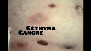 ecthyma causes symptoms and treatment dermatologyskin disease [upl. by Ahsilrae]