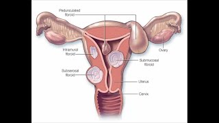 Mayo Clinic Minute  Nonsurgical treatment for uterine fibroids [upl. by Eikcor]