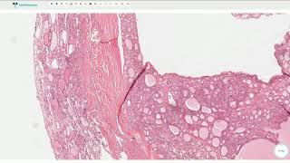 Follicular Adenoma  Thyroid Gland Histopathology [upl. by Sybyl]