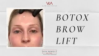 Treating BOTOX BROW LIFT with Botox  Skin Perfect Walnut Medical Spa Clinic [upl. by Chapell27]