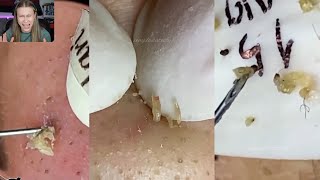 9 Minutes Of Top ASMR Pimple Popping Video [upl. by Coltson59]