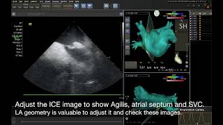 Transseptal puncture using CARTO3 system  ZeroFluoroscopy technique [upl. by Fadden]