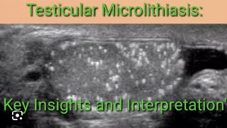 quotUltrasound Imaging of Testicular Microlithiasis Key Insights and Interpretationquot [upl. by Carlina362]