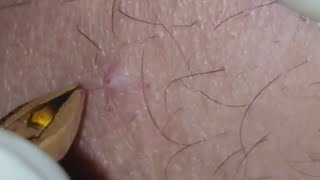 How to remove ingrown hair from armHow I removed my arm ingrown hair [upl. by Fidele]