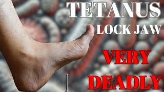 How Tetanus Can Be Very Fatal  Things to know [upl. by Lat]