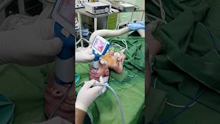 Newborn intubation using UE Miller 0 blade [upl. by Aisatan]