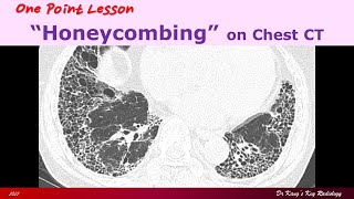 Honeycombing on Chest CT [upl. by Hamon]