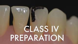 Class IV Preparation for Resin Composite [upl. by Esom665]