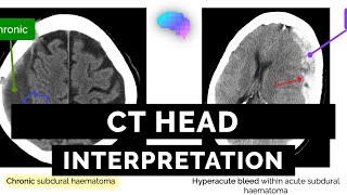 CT Head Interpretation for Beginners  OSCE Guide  UKMLA  CPSA [upl. by Orton]