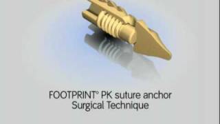 Intro FOOTPRINT PK suture anchor PartI  Simon Moyes Capital Orthopaedics [upl. by Eehc463]