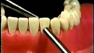 Tooth Mobility [upl. by Porte]