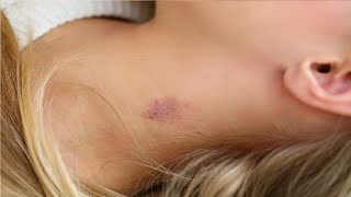 easy way to give someone a hickey for beginners [upl. by Caravette]