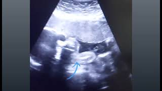 Anterior placenta with 28 weeks baby movements gender amp 3VCord  8 weeks pregnancy with heartbeat [upl. by Eanrahc]