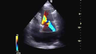 Echocardiography mitral valve stenosis ultrasound [upl. by Obellia]