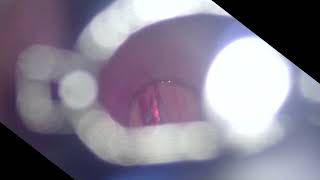 Anterior commissure leukoplakia [upl. by Lede]