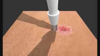 Skin Biopsy Simulation [upl. by Nikki]