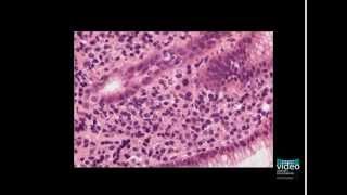 Nodular Gastritis [upl. by Maretz]