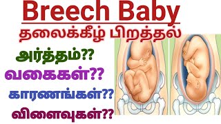 Breech Baby Position  Full InformationReasonsTypes and Treatment  How to turn breech baby [upl. by Macmahon]