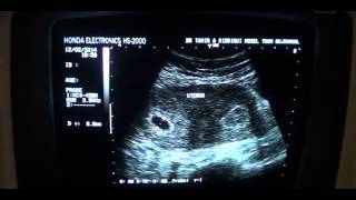 03 wks PREGNANCY in a SUB  SEPTATE UTERUS [upl. by Nitsu]