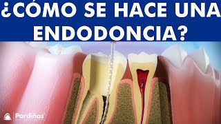 ¿Qué es una Endodoncia  Tratamiento de conductos o desvitalización del diente paso a paso © [upl. by Sibyls]