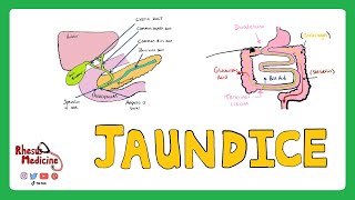 JAUNDICE Differential diagnosis of Jaundice  PrehepaticHepaticPost Hepatic Causes of Jaundice [upl. by Egrog76]